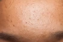 Lỗ chân lông bị tắc nghẽn, nổi mụn, cần làm gì để khắc phục?