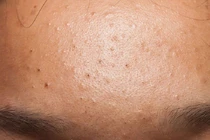 Lỗ chân lông bị tắc nghẽn, nổi mụn, cần làm gì để khắc phục?