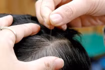 Trẻ em bị tóc bạc sớm có phải là dấu hiệu cảnh báo của bệnh lý?