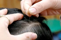 Trẻ em bị tóc bạc sớm có phải là dấu hiệu cảnh báo của bệnh lý?