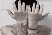 "Tiền mất tật mang" vì tự mua thuốc trên mạng bôi chữa ngứa 