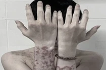 "Tiền mất tật mang" vì tự mua thuốc trên mạng bôi chữa ngứa 