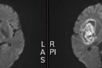 Xuất huyết não vì tự ý bỏ thuốc huyết áp