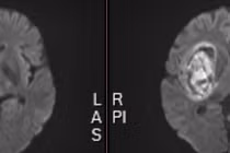 Xuất huyết não vì tự ý bỏ thuốc huyết áp