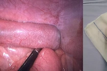 Gắp 4 viên nam châm trong ruột bé trai 7 tuổi