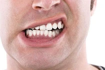 Thói quen xấu có thể gây biến dạng khuôn mặt, bất ngờ số 1