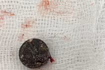 Pin cúc áo "ăn mòn" vách ngăn mũi bé trai 5 tuổi