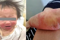 Cảnh giác viêm da cơ địa ở trẻ nhỏ trong mùa hanh khô