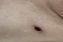 Suy đa tạng do sốt mò, dấu hiệu mắc bệnh cần lưu ý