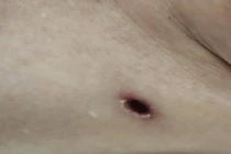 Suy đa tạng do sốt mò, dấu hiệu mắc bệnh cần lưu ý