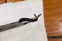 Con vắt dài 5cm sống trong mũi bé 32 tháng tuổi, gây chảy máu kéo dài