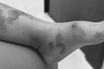 Cảnh báo nguy cơ lây lan bệnh chốc ở trường học