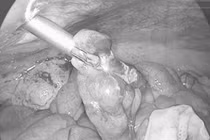 Nam sinh 16 tuổi suýt gặp nguy hiểm do tự chữa đau bụng tại nhà