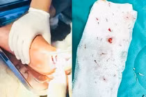 Hơn 30 con giòi làm tổ trong vết thương của cụ ông 85 tuổi