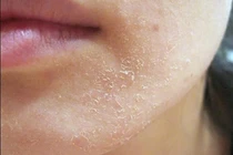 Bí quyết xua tan nỗi ám ảnh khô da trong mùa đông