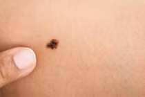Dấu hiệu cảnh báo ung thư tế bào hắc tố, nhiều người nhầm lẫn