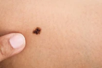 Dấu hiệu cảnh báo ung thư tế bào hắc tố, nhiều người nhầm lẫn