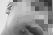 Tự ý nặn mụn trên mặt có thể dẫn tới nhiễm khuẩn huyết