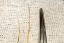 Thủng tá tràng, sốc nhiễm trùng nặng do... xương cá