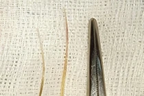 Thủng tá tràng, sốc nhiễm trùng nặng do... xương cá