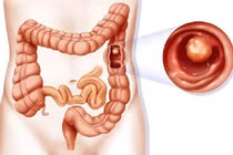 Đi ngoài liên tục, sút cân… đi khám bất ngờ phát hiện ung thư trực tràng