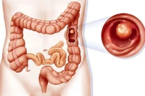 Đi ngoài liên tục, sút cân… đi khám bất ngờ phát hiện ung thư trực tràng