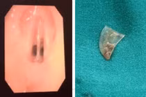 Mảnh nhựa "ngủ quên" giữa 2 dây thanh suốt 4 tháng