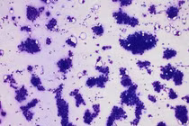 Nổi hạch vùng nách, triệu chứng tuyệt đối không nên chủ quan 