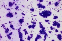 Nổi hạch vùng nách, triệu chứng tuyệt đối không nên chủ quan 