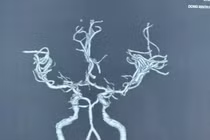 Người phụ nữ đột ngột yếu nửa người sau khi ngủ dậy 