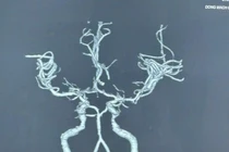 Người phụ nữ đột ngột yếu nửa người sau khi ngủ dậy 