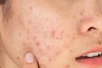 Vì sao da nổi mụn khi đến kỳ "đèn đỏ"?