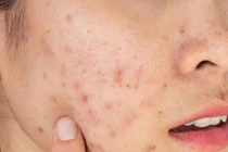 Vì sao da nổi mụn khi đến kỳ "đèn đỏ"?