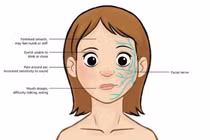 Bé gái 15 tháng tuổi đột ngột liệt dây thần kinh số VII ngoại biên