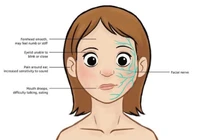 Bé gái 15 tháng tuổi đột ngột liệt dây thần kinh số VII ngoại biên