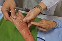 Bị kiến lửa đốt, người phụ nữ 57 tuổi nhiễm trùng huyết nguy kịch