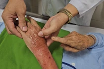 Bị kiến lửa đốt, người phụ nữ 57 tuổi nhiễm trùng huyết nguy kịch