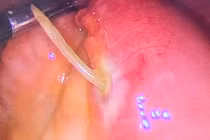 Xương cá xuyên thủng thành ruột non cụ bà 61 tuổi