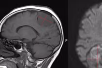 Đau đầu dai dẳng, đi khám bất ngờ phát hiện u màng não