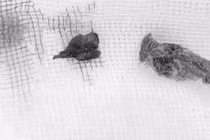 Gắp thành công dị vật trong âm đạo bé gái 5 tuổi