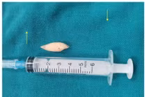 Lấy dị vật đường thở cho bệnh nhân hôn mê do chấn thương sọ não nặng