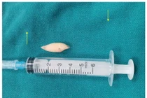 Lấy dị vật đường thở cho bệnh nhân hôn mê do chấn thương sọ não nặng