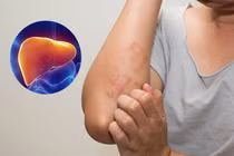Dấu hiệu trên da cảnh báo gan nhiễm mỡ, cần đi khám ngay