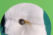 Gắp viên bi sắt trong mũi bé gái 3 tuổi