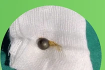 Gắp viên bi sắt trong mũi bé gái 3 tuổi