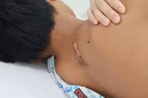 Cứu sống bé trai 13 tuổi ngưng thở, ngưng tim 15 phút do sét đánh