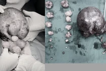 Bóc tách thành công khối u xơ tử cung xoắn tím đen kích thước "khủng"