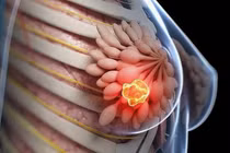 Không nên chủ quan với bệnh ung thư vú
