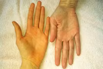 Đột ngột sốt cao, vàng da, vàng mắt, đi khám phát hiện viêm gan A