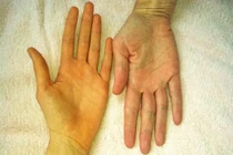 Đột ngột sốt cao, vàng da, vàng mắt, đi khám phát hiện viêm gan A